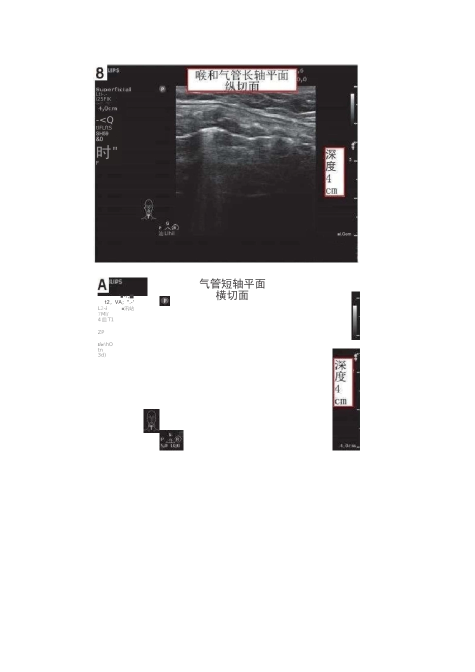 超声引导下的经皮气管切开技术_第3页
