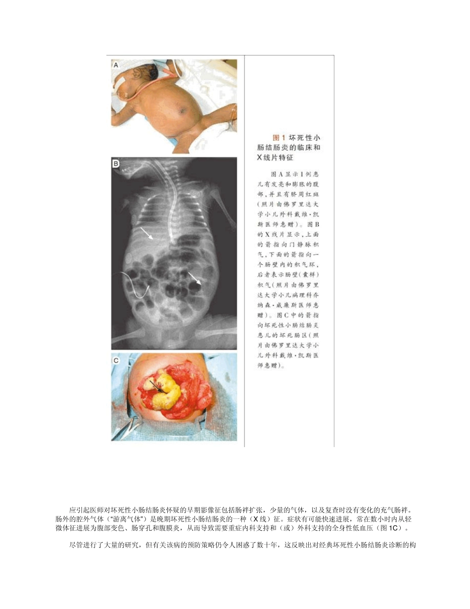 坏死性小肠结肠炎_第2页