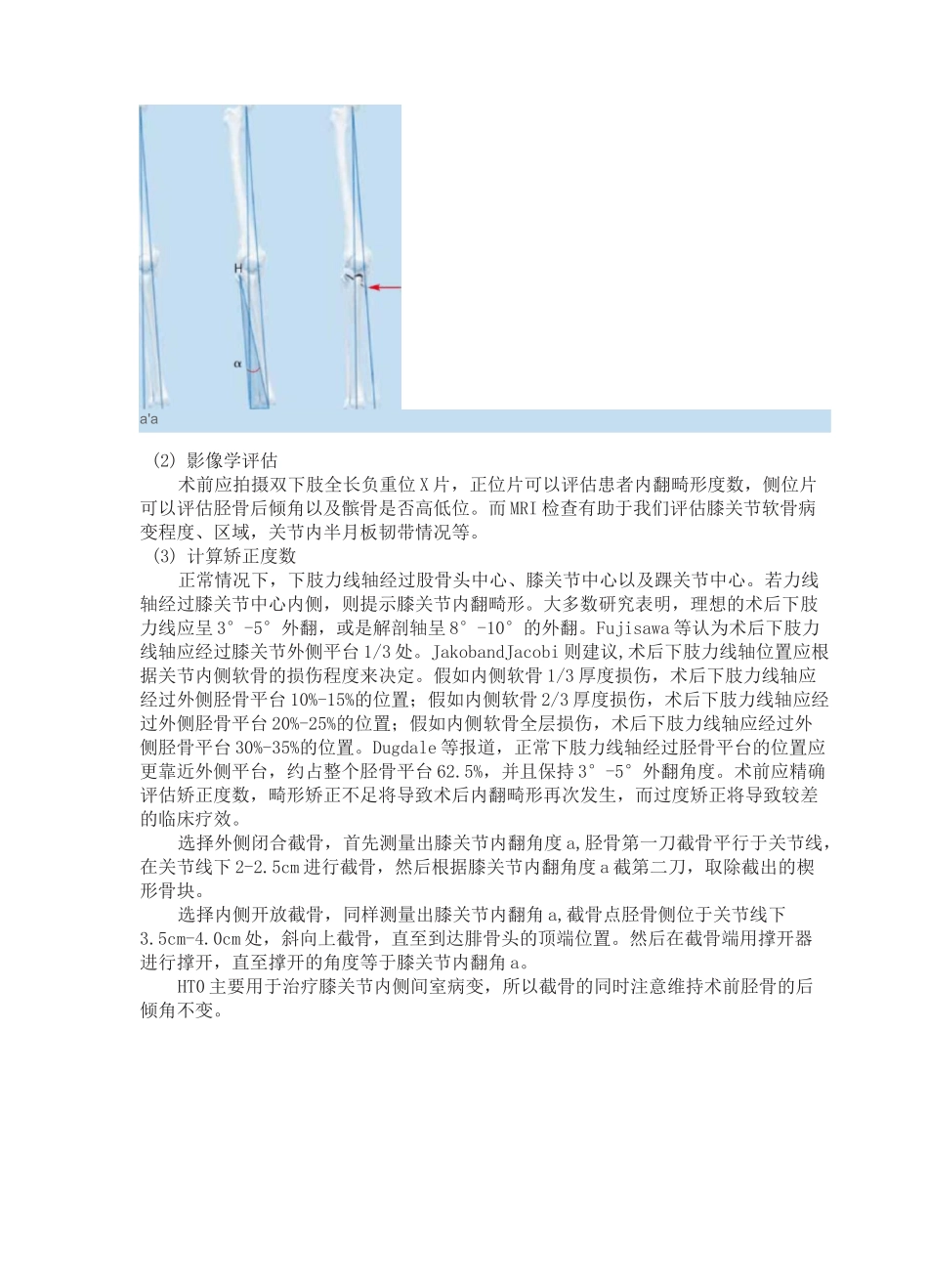 胫骨高位截骨术保膝治疗膝关节骨关节炎_第2页
