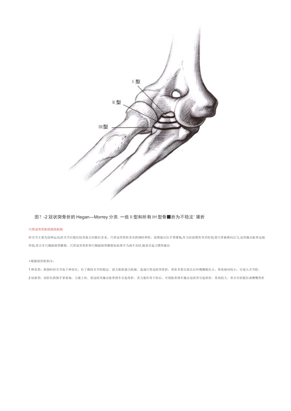 尺骨冠突骨折_第2页