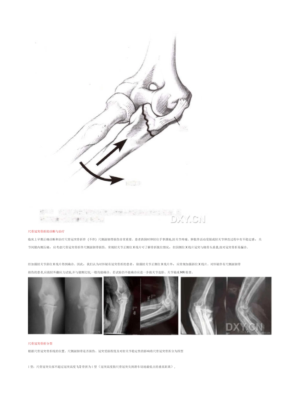 尺骨冠突骨折_第3页