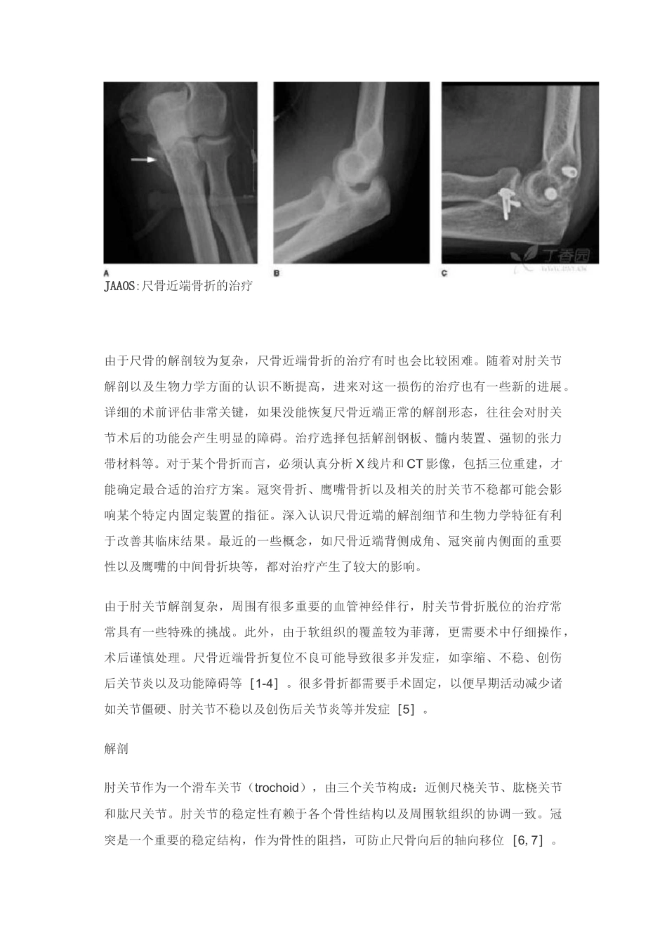 尺骨近端骨折的治疗_第2页