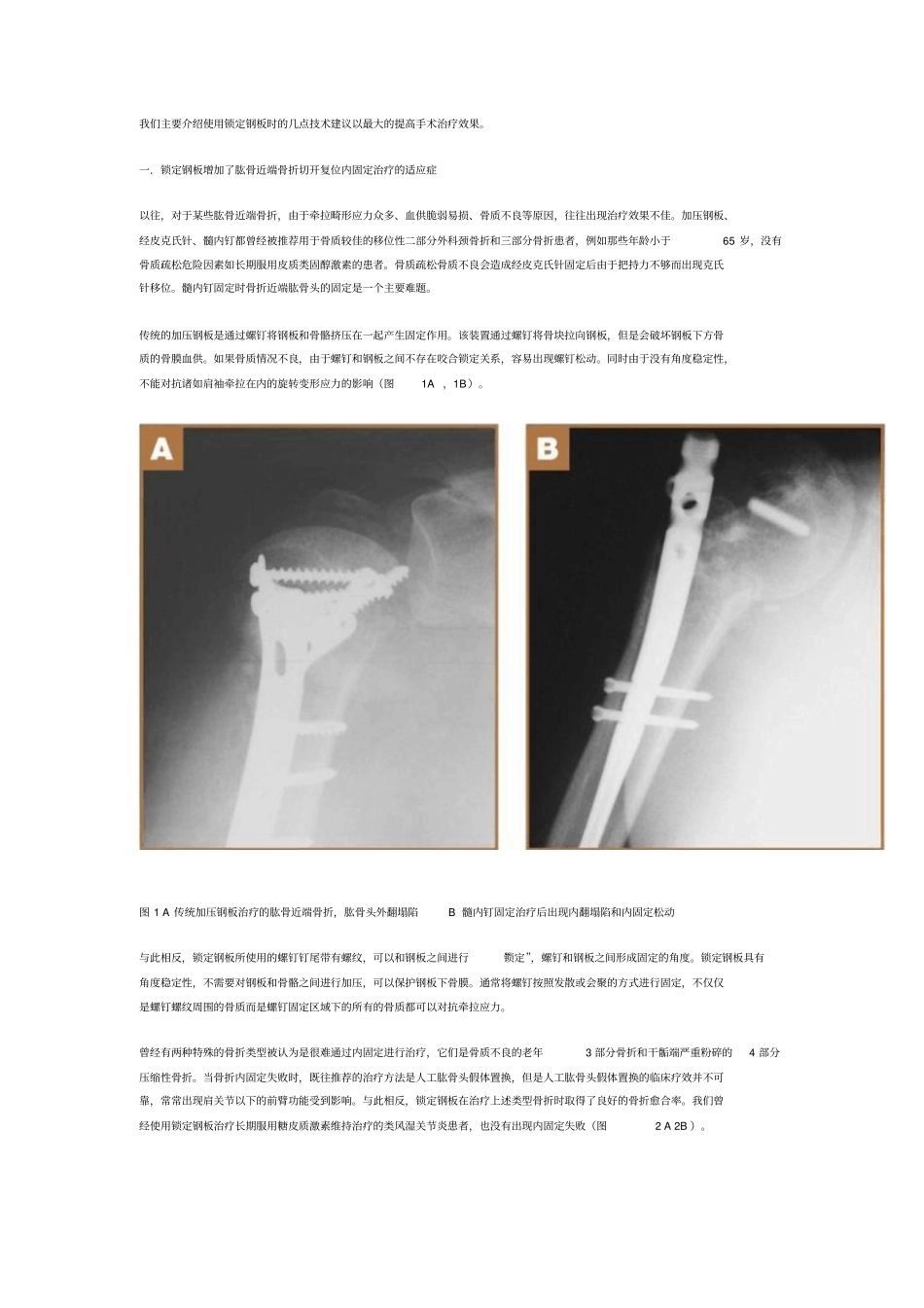 我们主要简介使用锁定钢板时几点技术建议以最大提高手术治疗效果_第1页