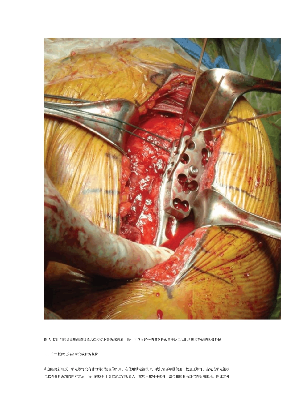 我们主要简介使用锁定钢板时几点技术建议以最大提高手术治疗效果_第3页