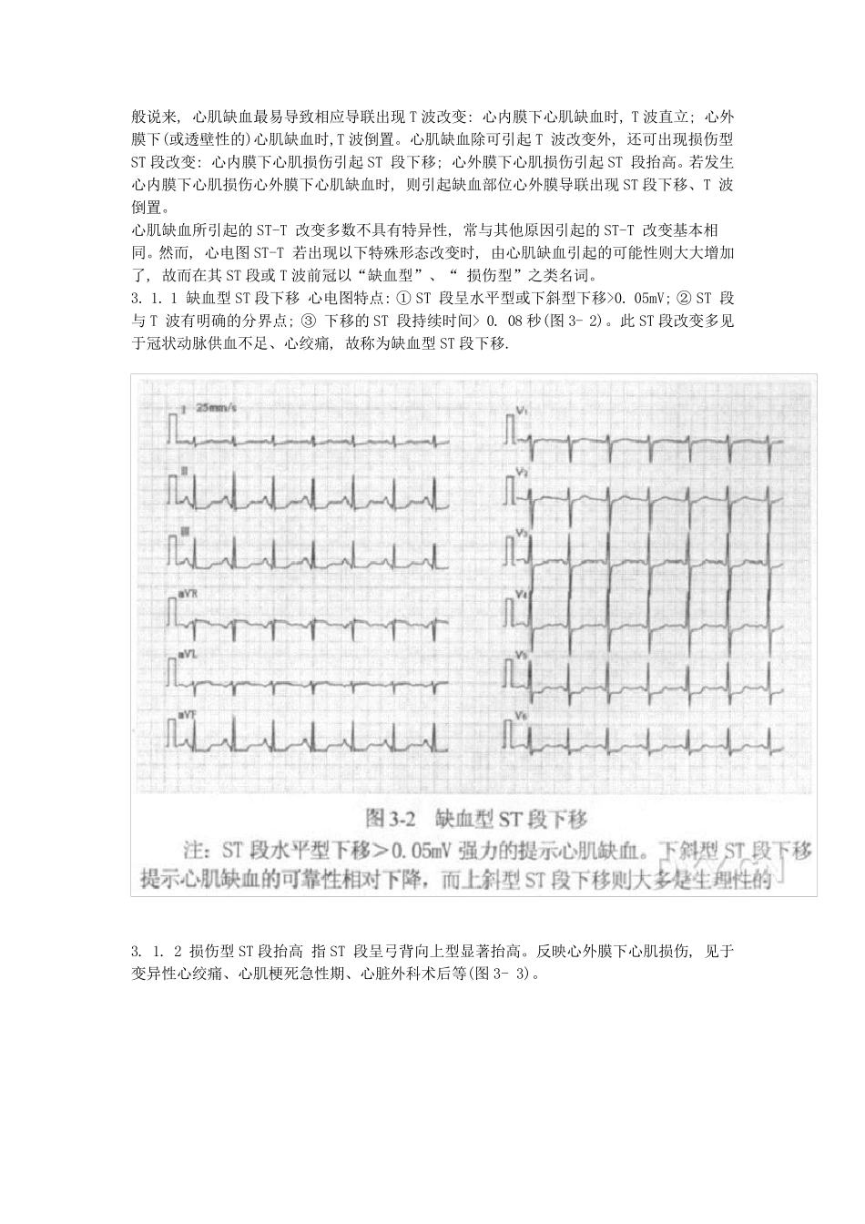 STT改变的临床意义_第3页