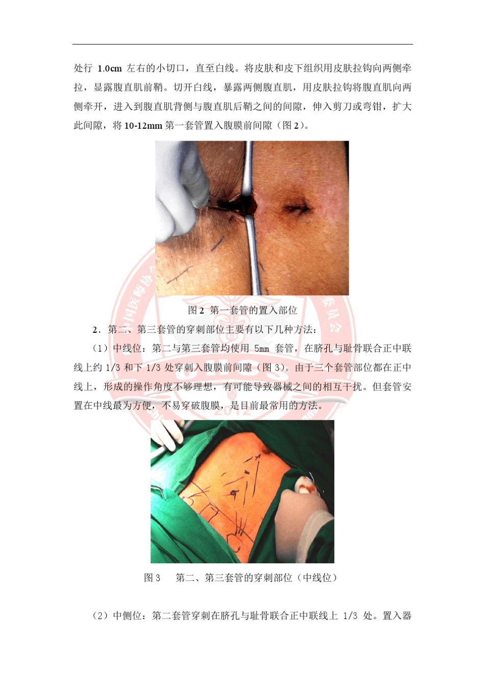 TEP的手术步骤和规范要求_第2页