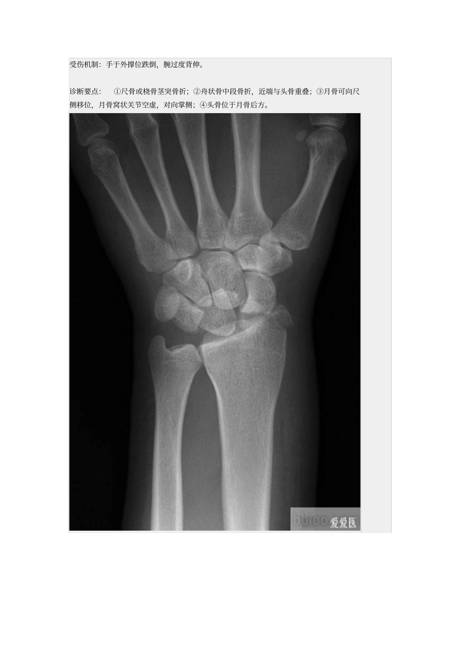 手骨脱位小骨详解_第2页