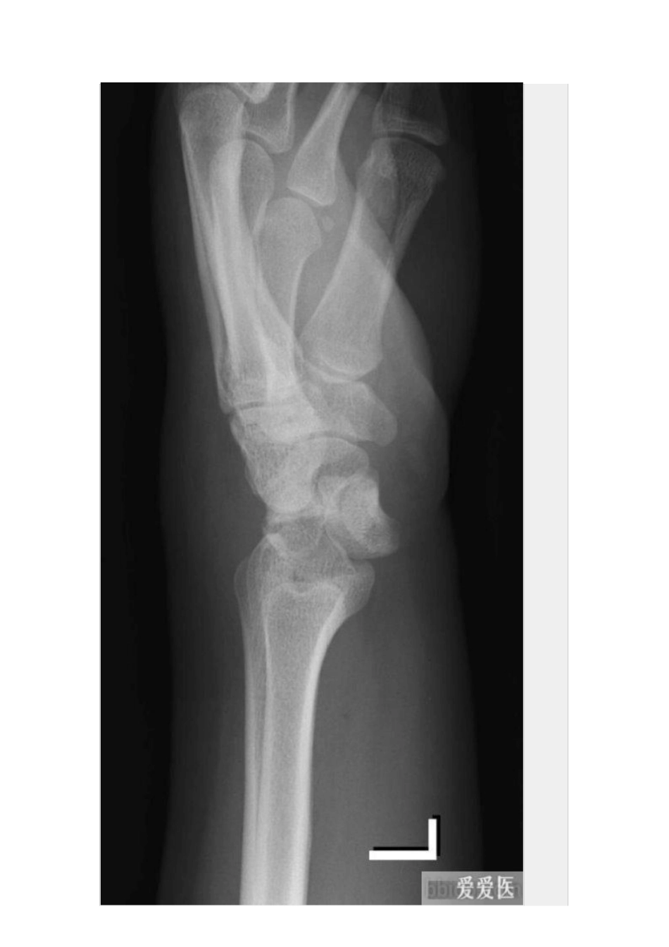 手骨脱位小骨详解_第3页