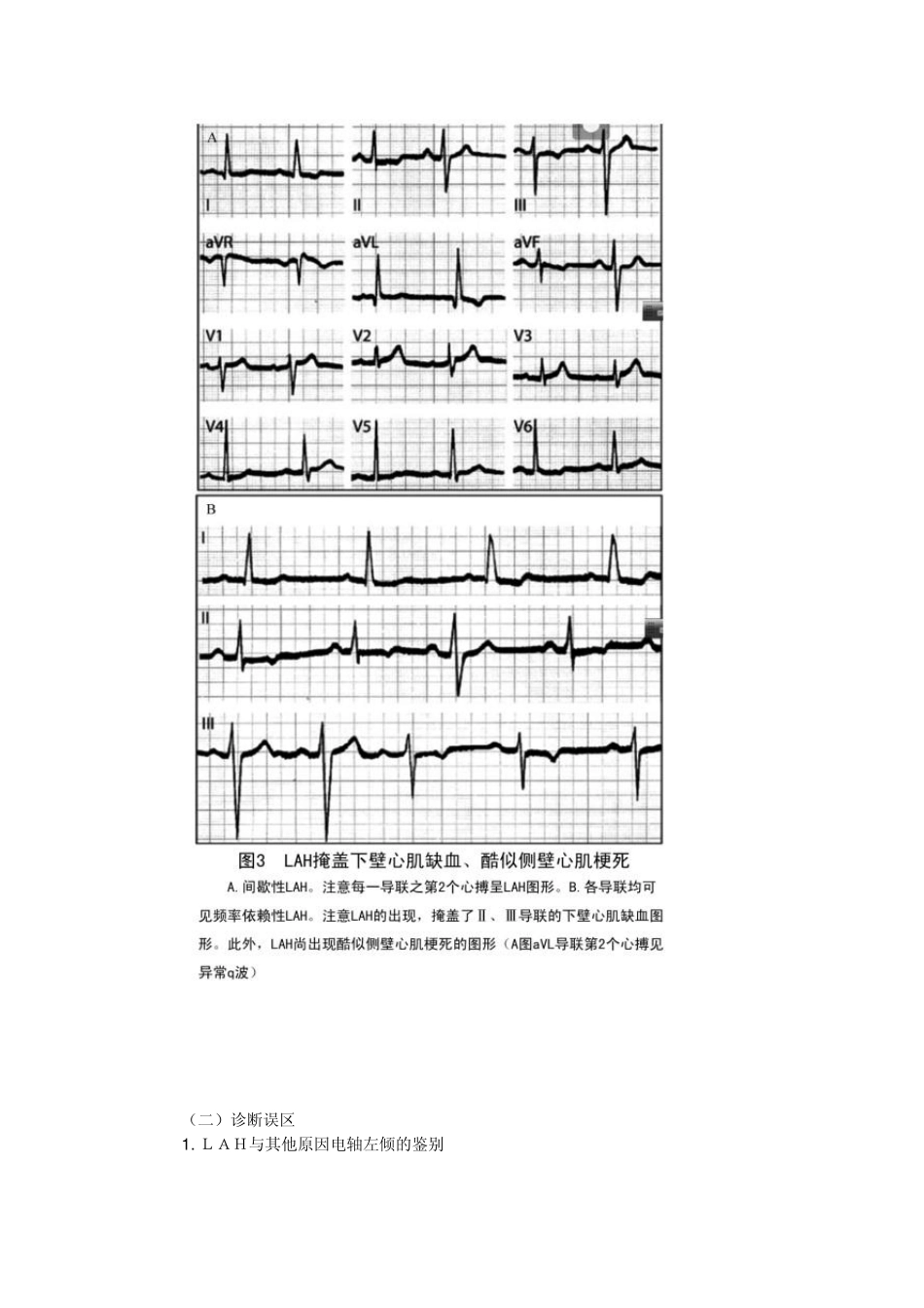 复杂性左束支分支阻滞的心电图诊断_第3页