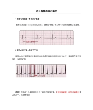2025年怎么看懂异常心电图