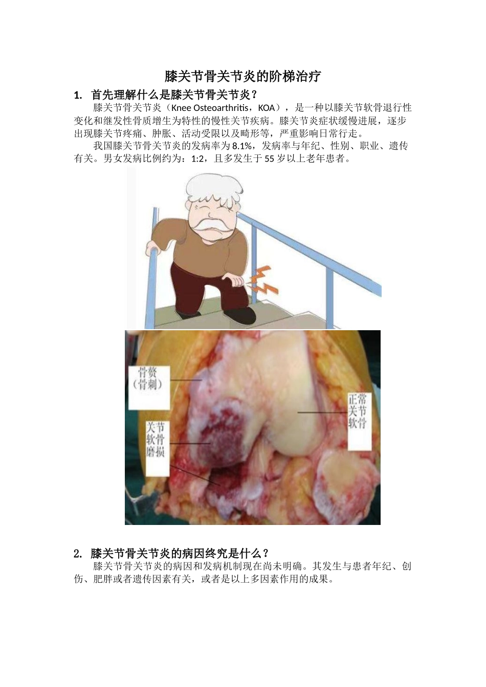 2025年膝关节骨关节炎的阶梯治疗_第1页