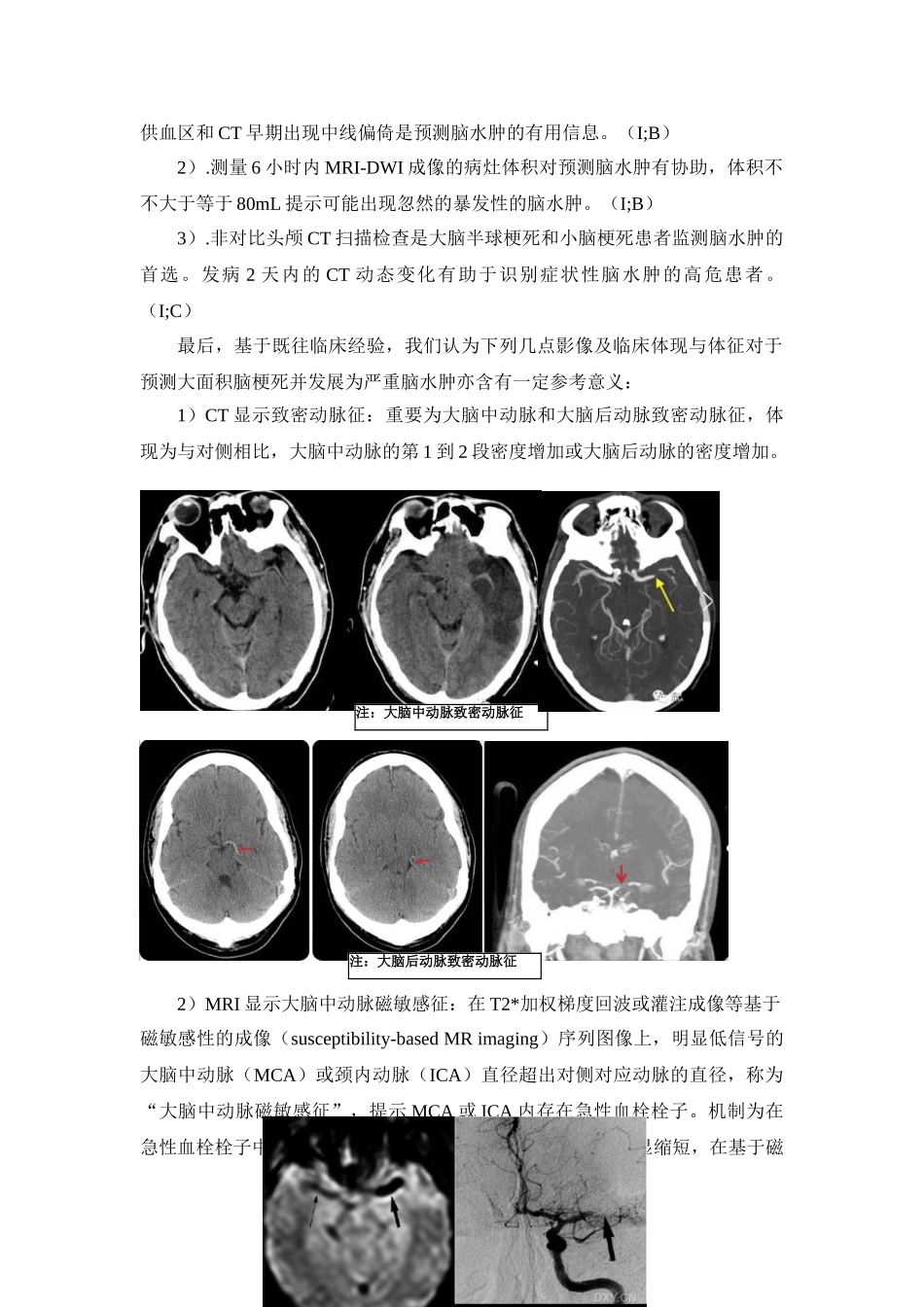 2025年脑卒中规范化诊治简明手册脑水肿和颅高压_第3页