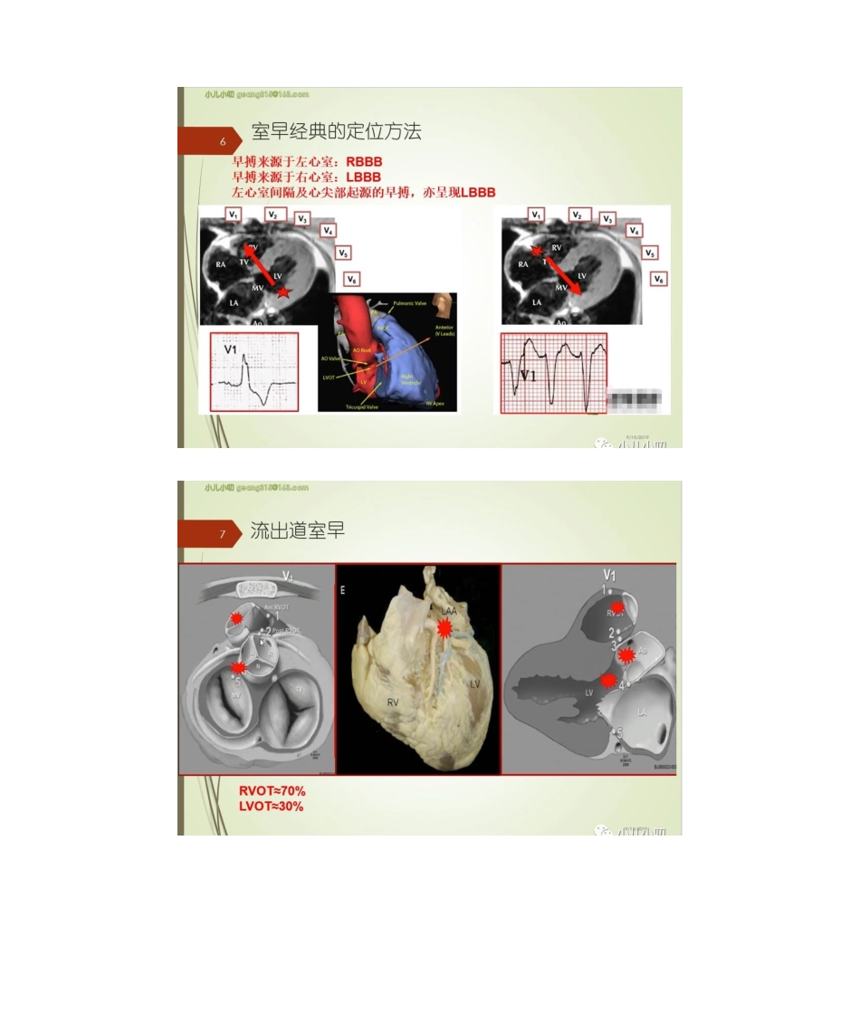 2025年室性早搏的定位特点_第2页