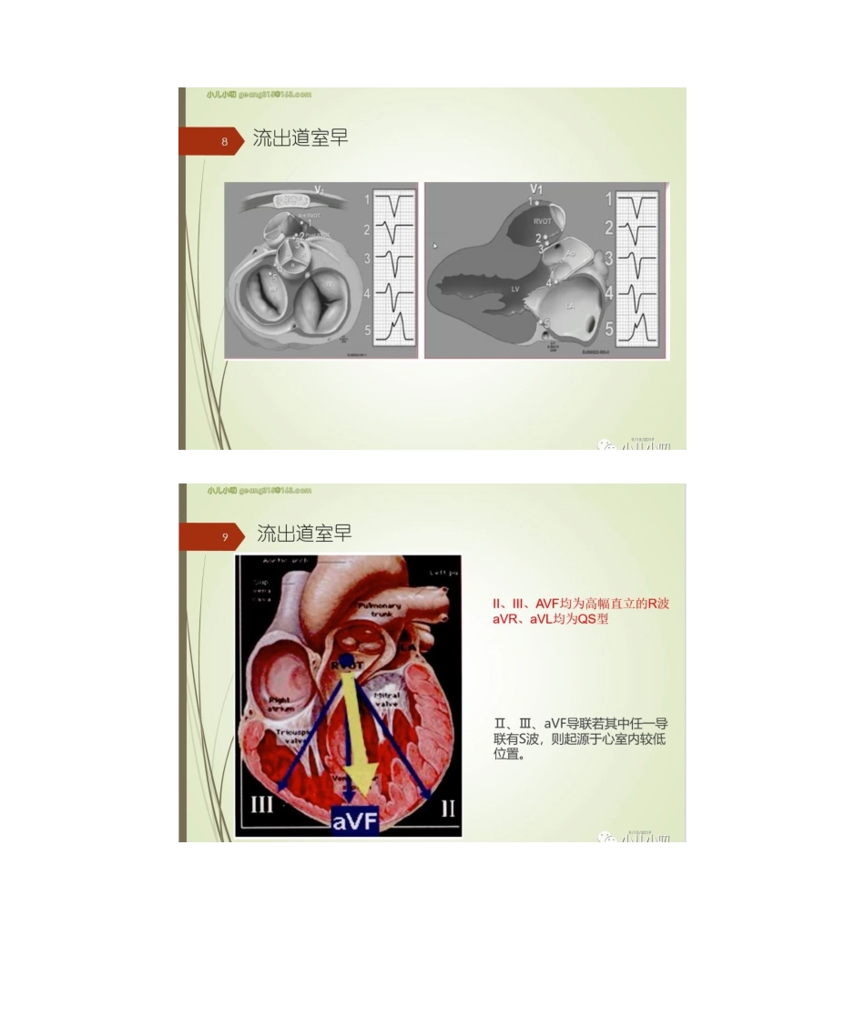 2025年室性早搏的定位特点_第3页