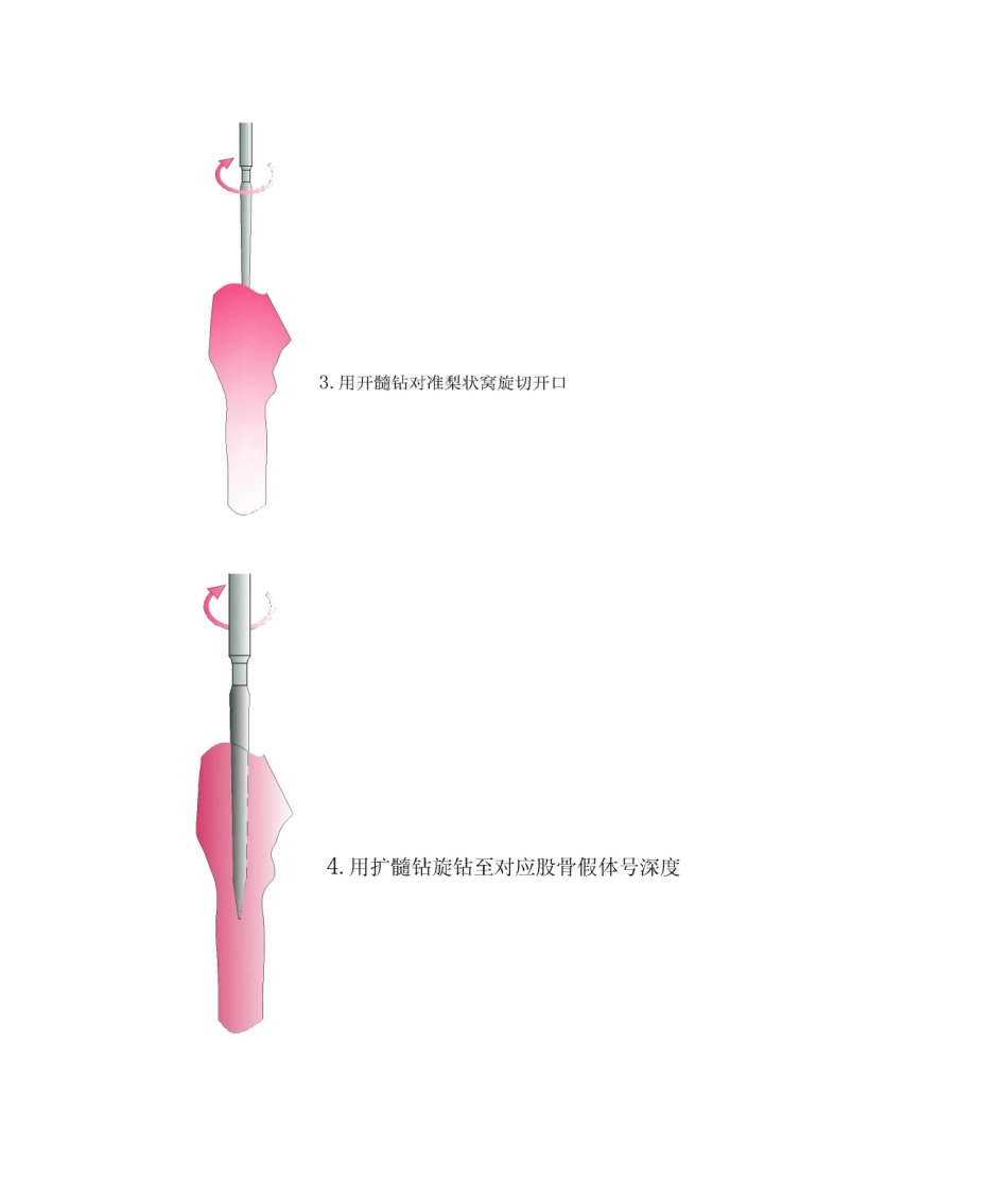 2025年髋关节置换手术操作流程_第2页