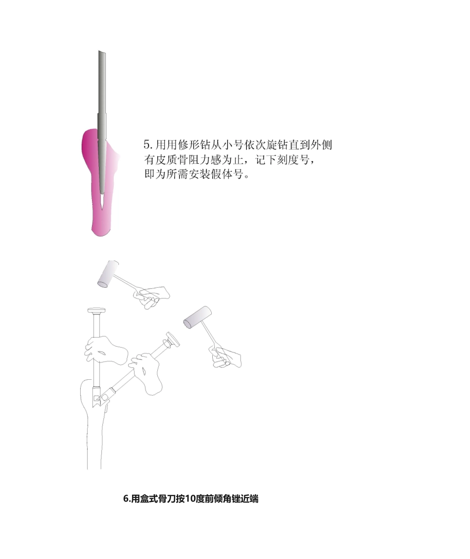 2025年髋关节置换手术操作流程_第3页