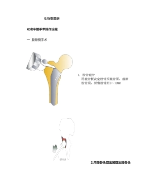 2025年髋关节置换手术操作流程