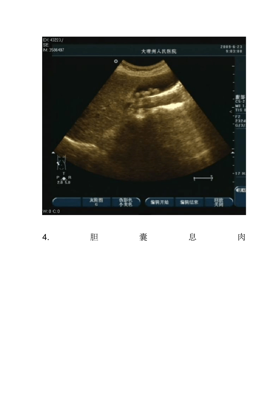 常见超声图谱_第3页