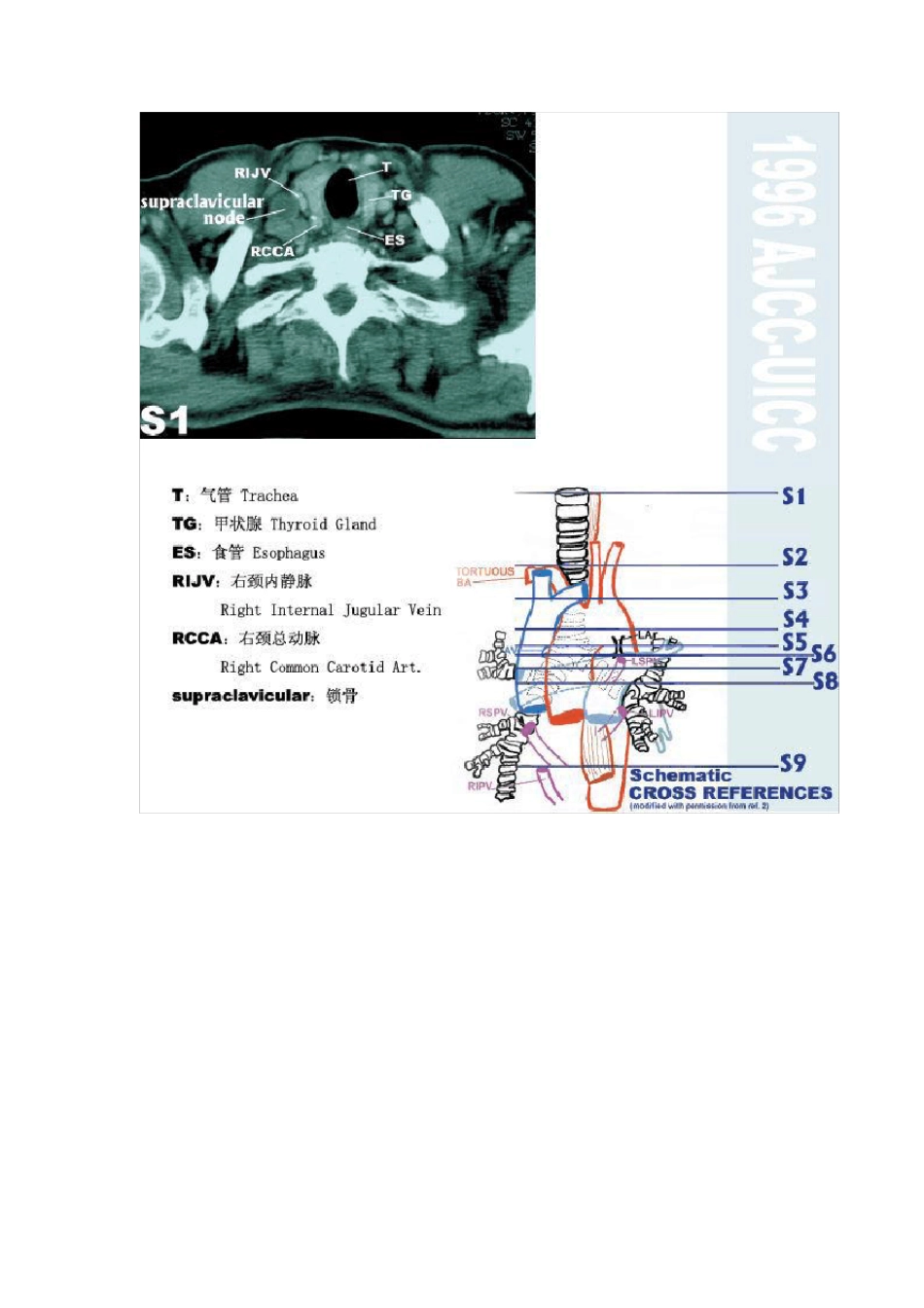 纵膈淋巴结分区最新版图谱_第2页