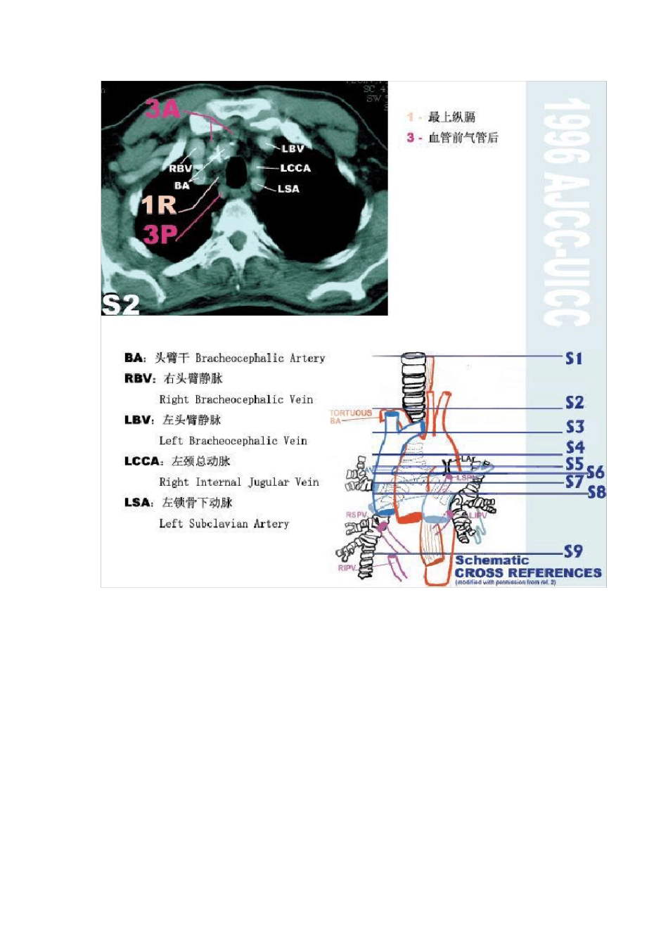 纵膈淋巴结分区最新版图谱_第3页