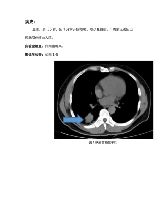 肺脓肿CT诊断及鉴别