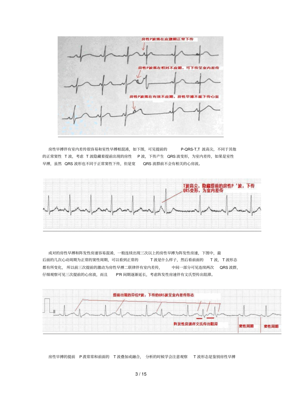 早搏诊断和鉴别诊断_第3页
