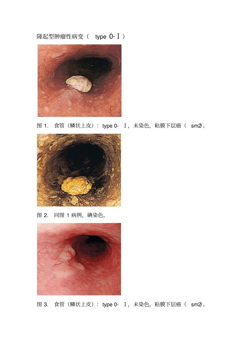 早癌的内镜下表现_第1页
