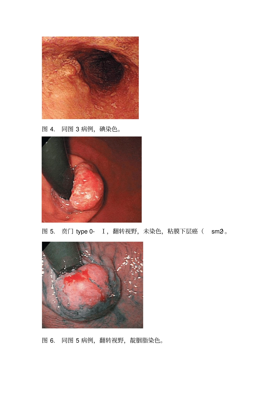 早癌的内镜下表现_第2页