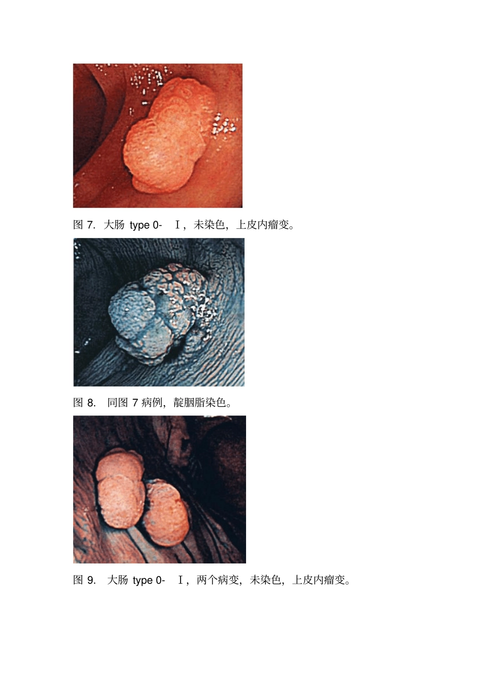 早癌的内镜下表现_第3页