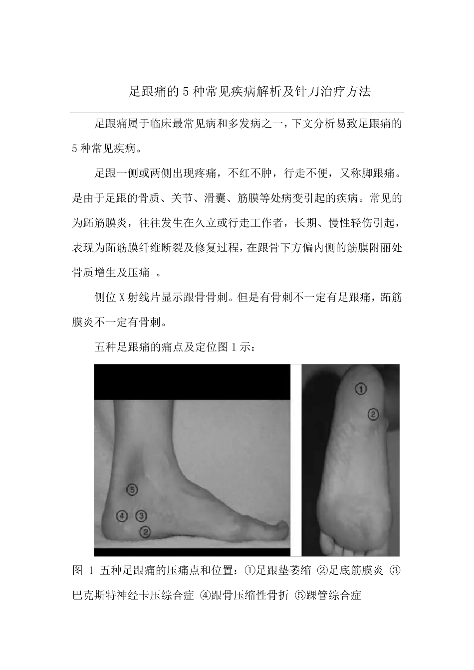 足跟痛的5种常见疾病解析及针刀治疗方法_第1页