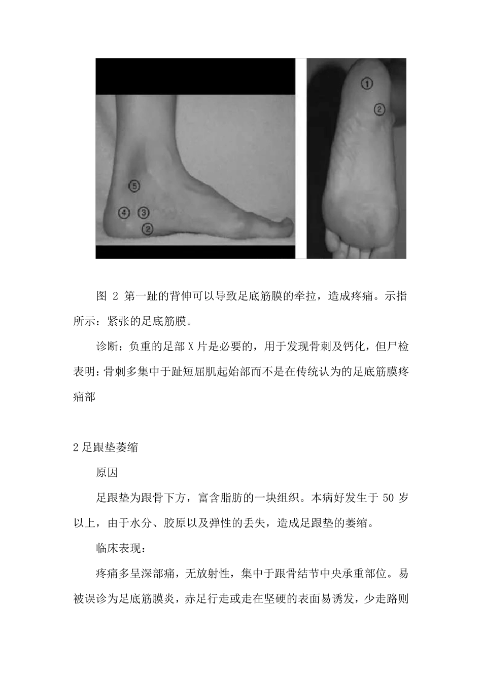 足跟痛的5种常见疾病解析及针刀治疗方法_第3页
