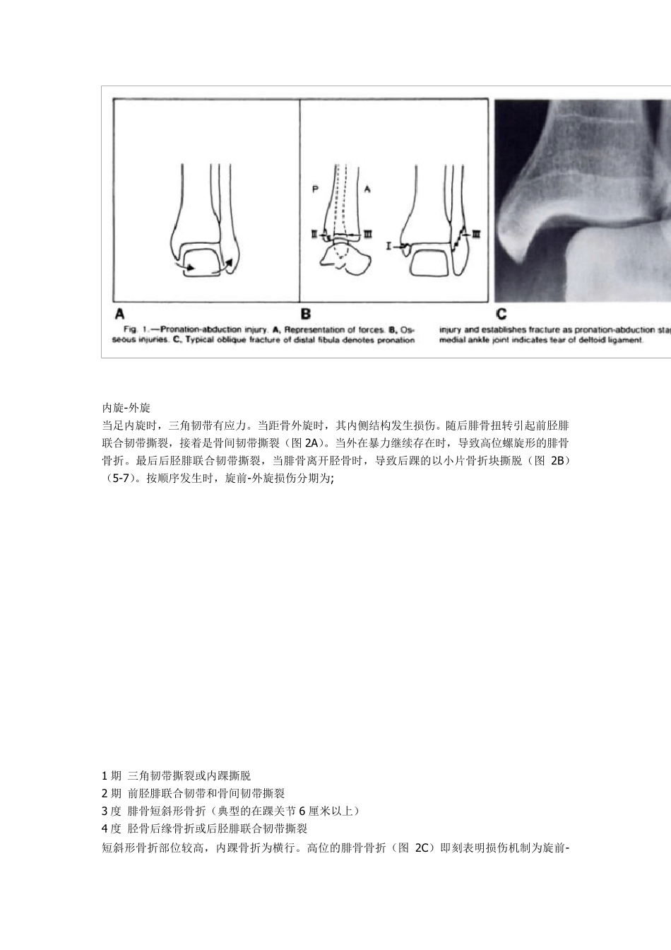 踝关节骨折分类系统(LaugeHansen分型)_第2页