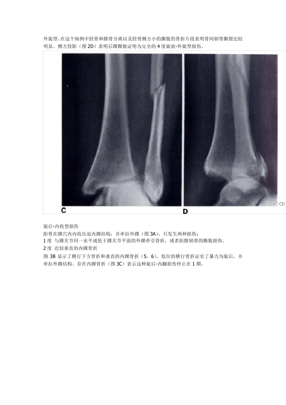 踝关节骨折分类系统(LaugeHansen分型)_第3页