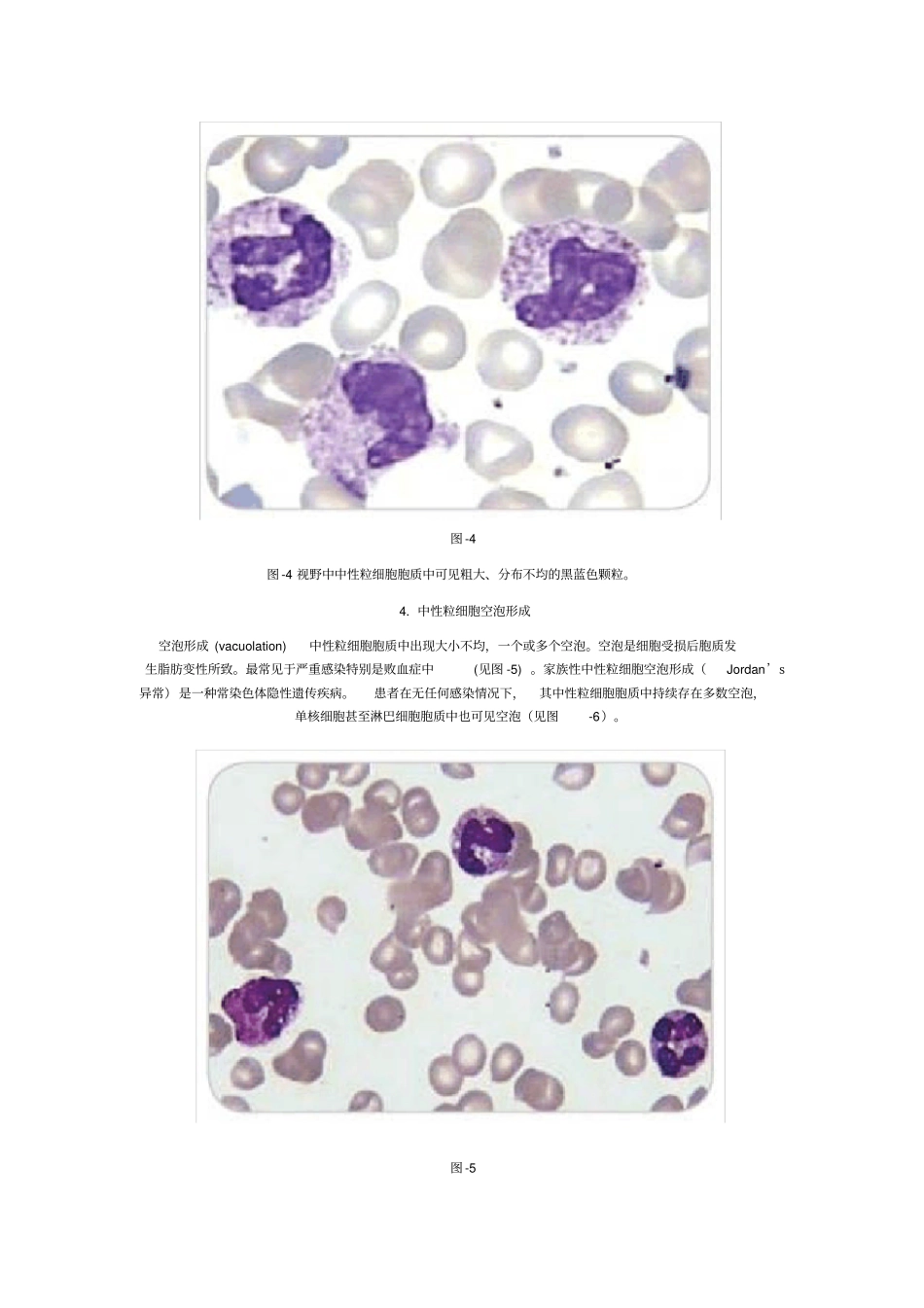 末梢血涂片白细胞形态变化及临床意义_第3页