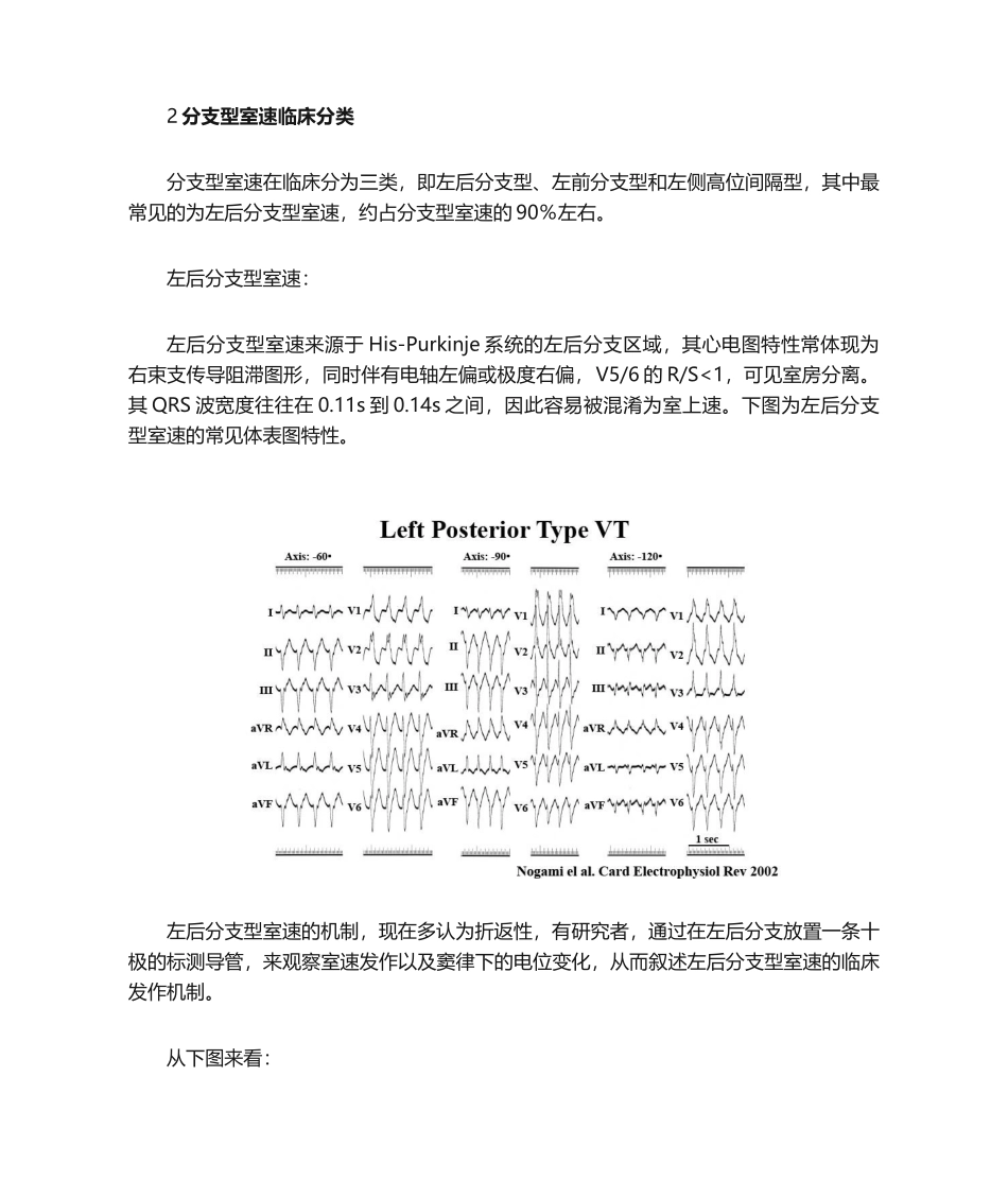 2025年杨平珍分支型室速的电生理诊断和消融_第2页