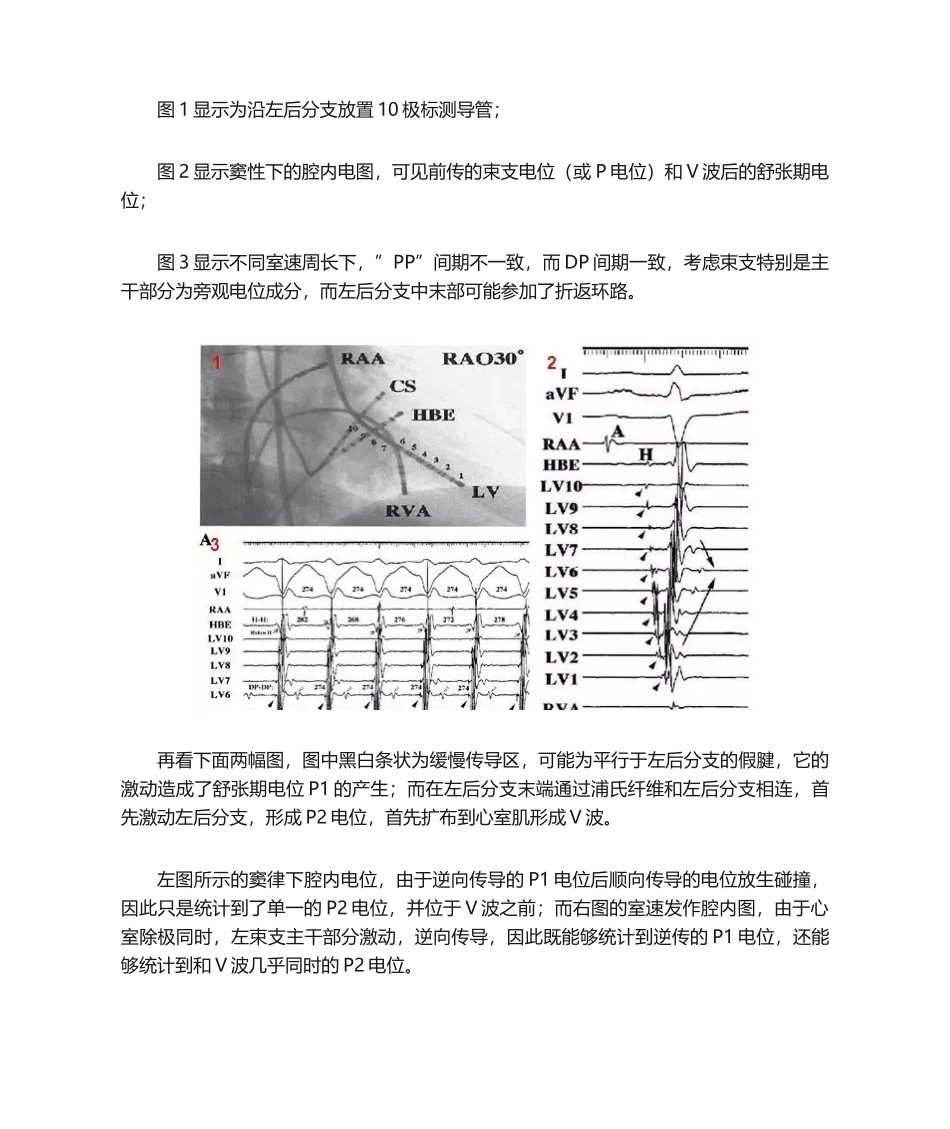 2025年杨平珍分支型室速的电生理诊断和消融_第3页
