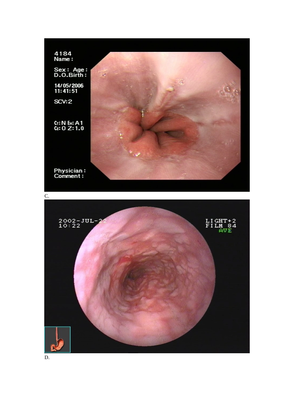 2025年消化内镜诊疗图谱胃食管反流病_第2页