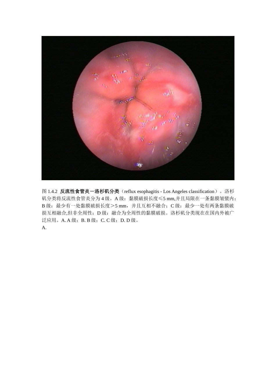 2025年消化内镜诊疗图谱胃食管反流病_第3页
