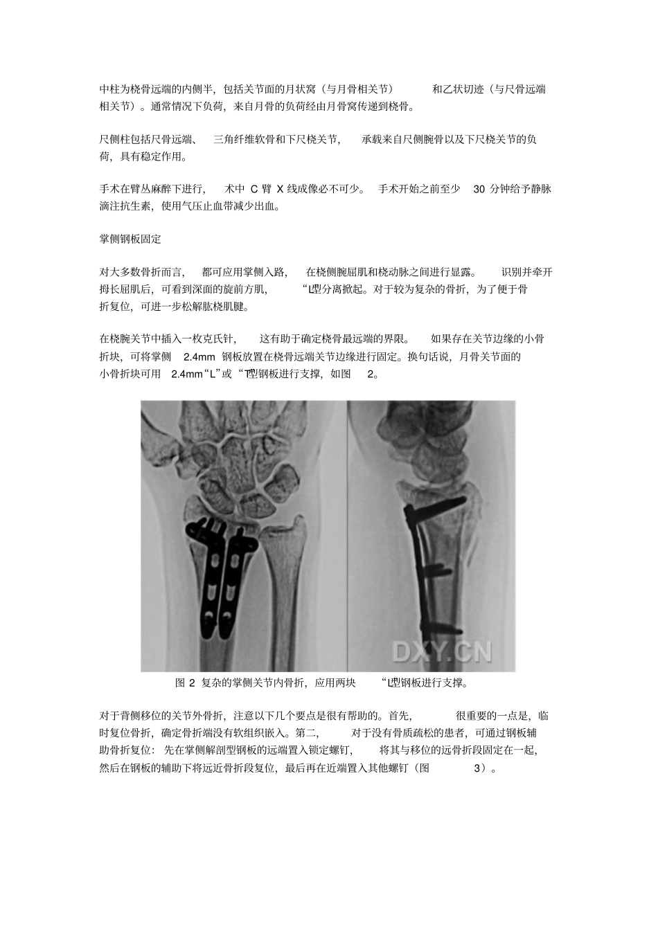 桡骨远端骨折锁定钢板内固定：手术技巧整理_第2页