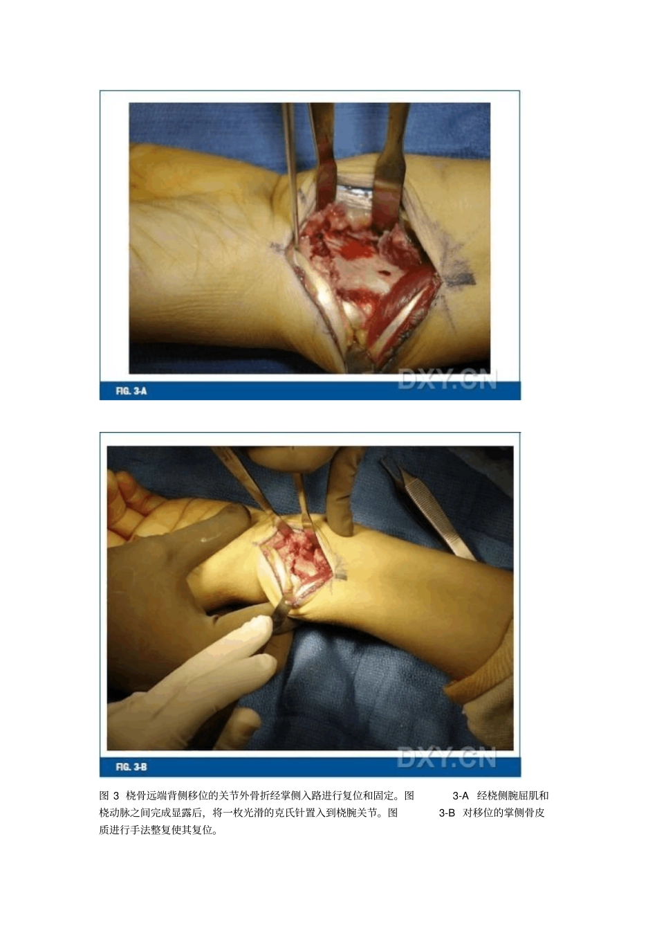 桡骨远端骨折锁定钢板内固定：手术技巧整理_第3页