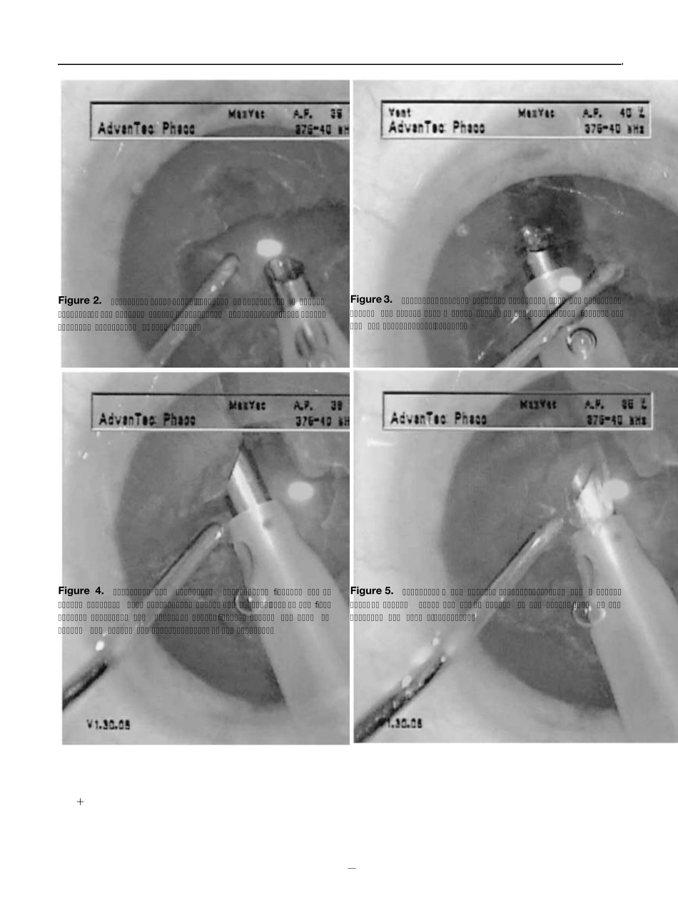 LOCSIII白内障分级权威_第3页