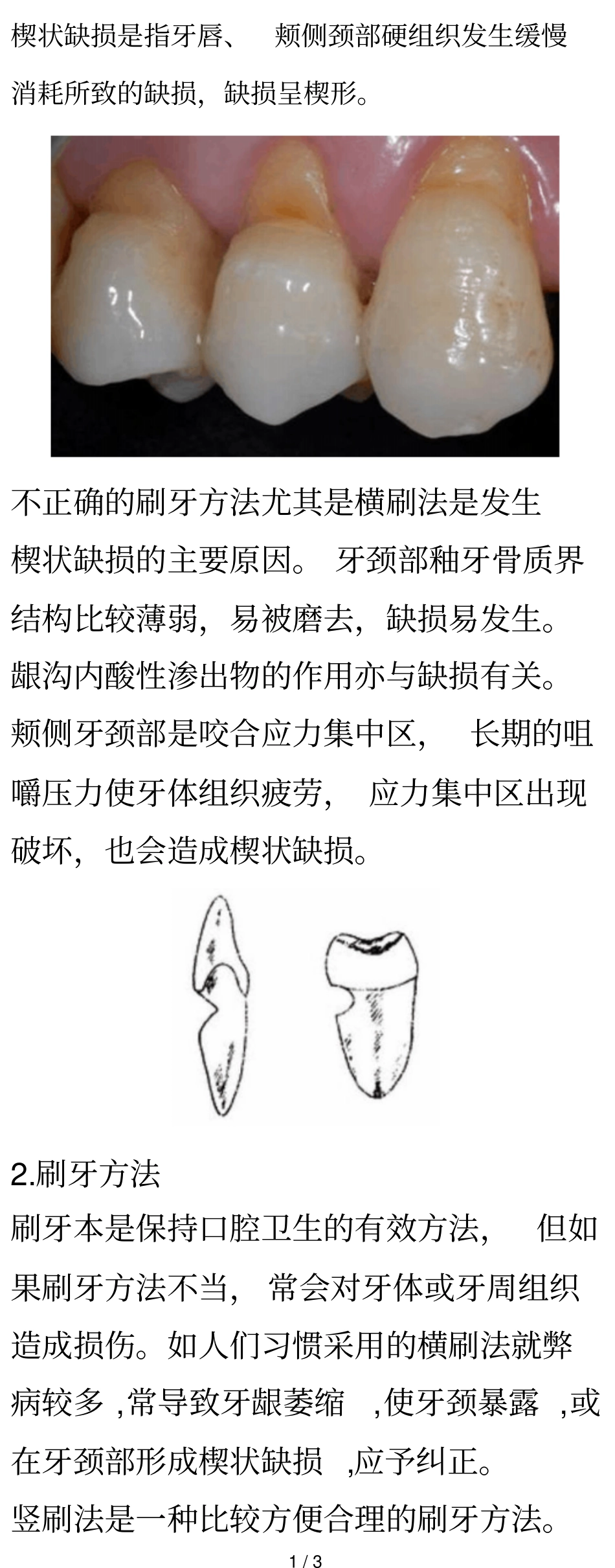 楔状缺损与正确刷牙方法@社区卫生教育_第1页