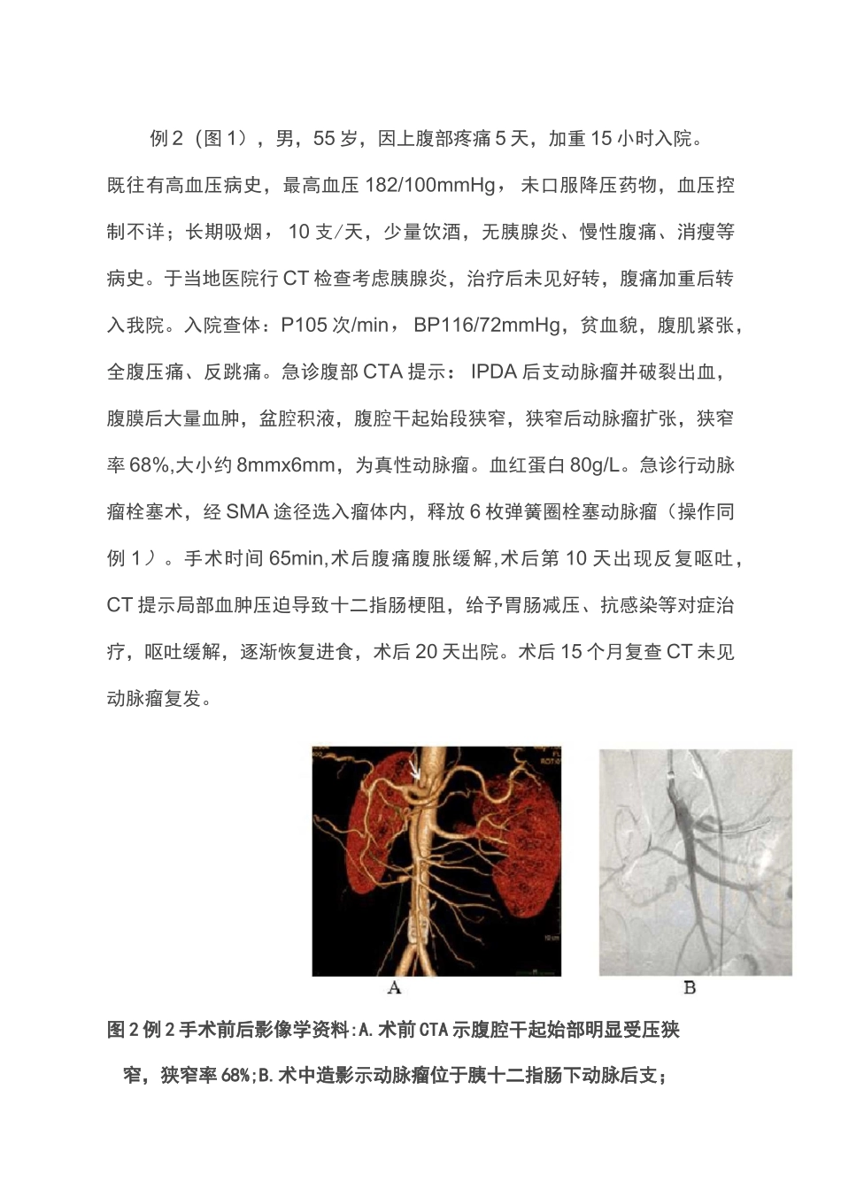 正中弓状韧带压迫合并胰十二指肠下动脉瘤诊治策略(全文)_第3页