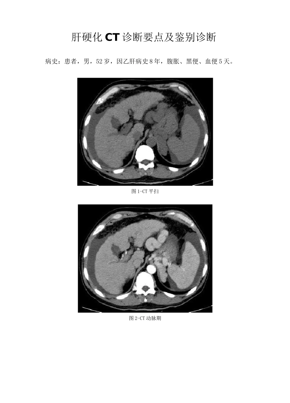 肝硬化CT诊断要点及鉴别诊断_第1页