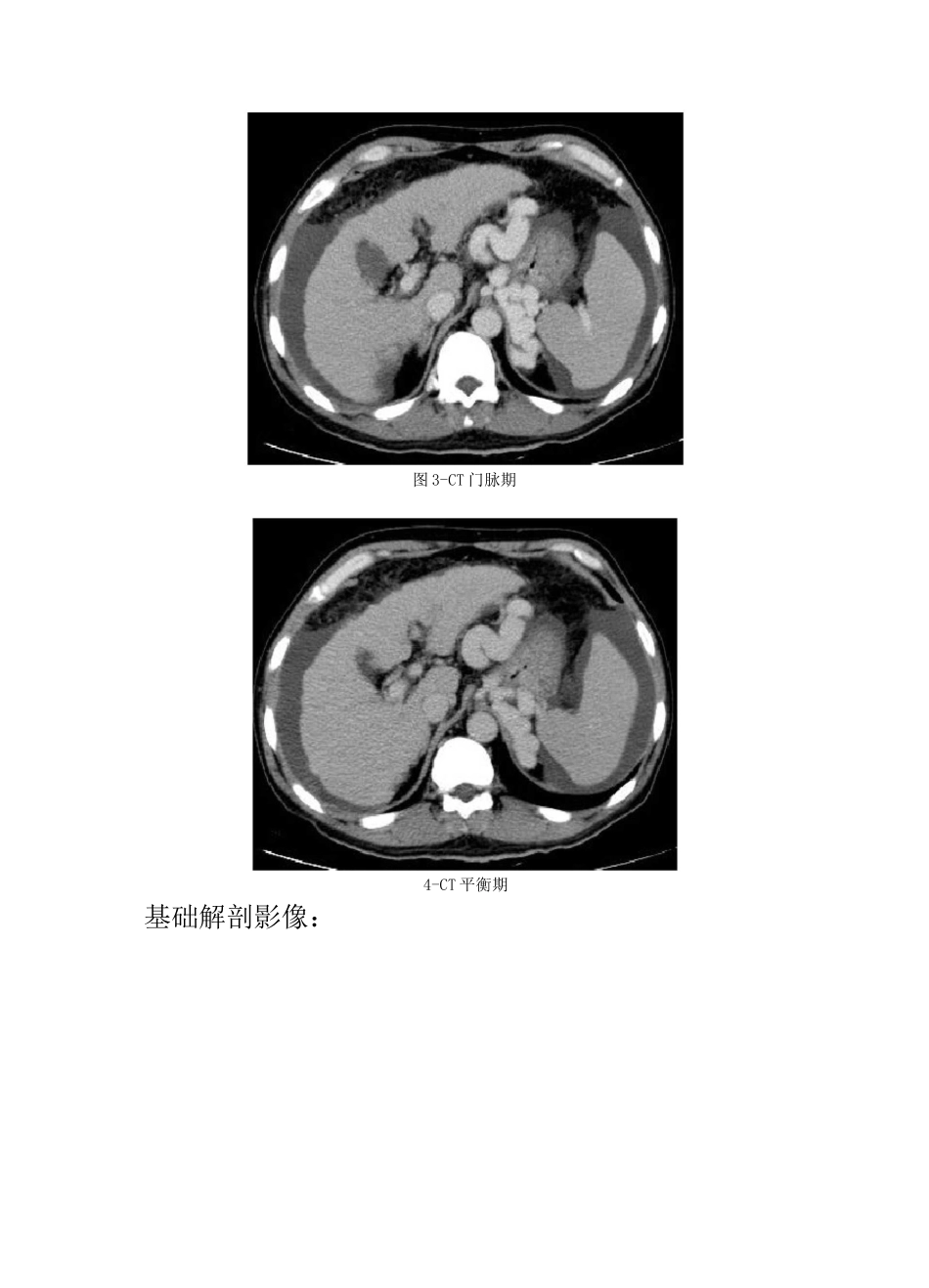 肝硬化CT诊断要点及鉴别诊断_第2页