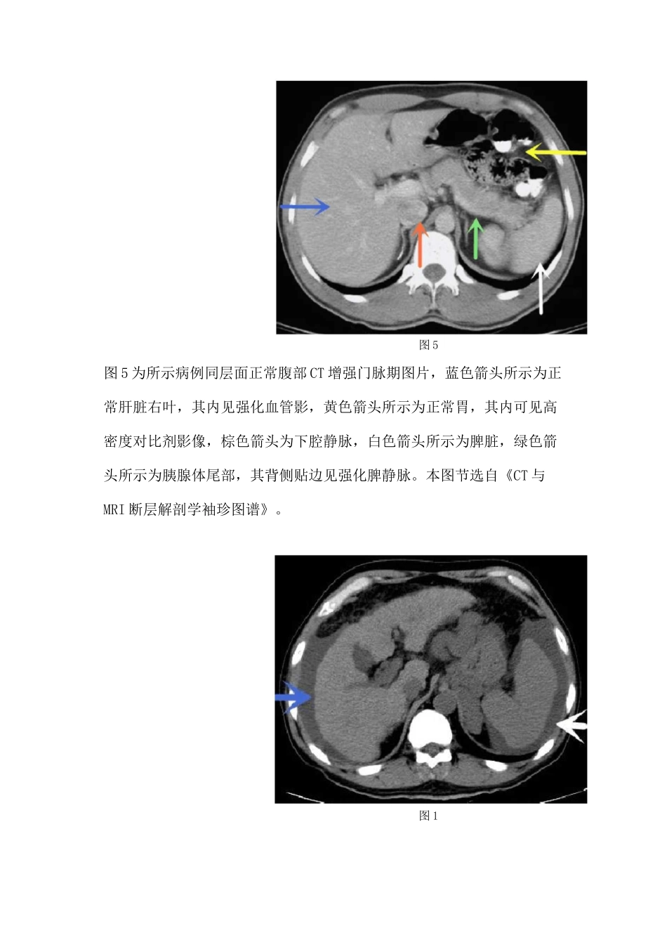 肝硬化CT诊断要点及鉴别诊断_第3页
