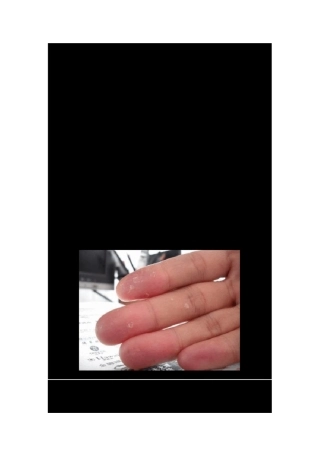 治疗手脱皮的方法