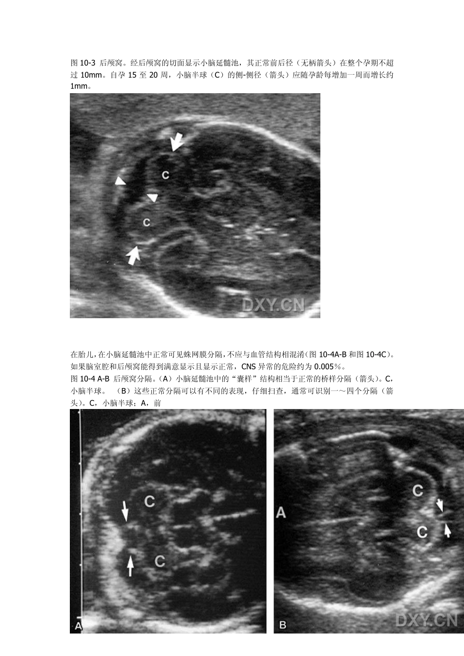 产科超声胎儿头部和脑_第3页