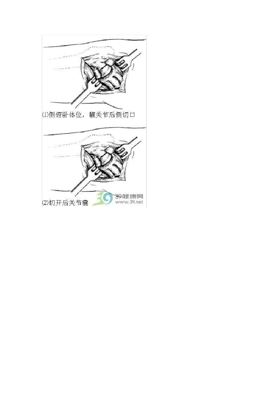 人工股骨头置换术手术步骤详解_第3页