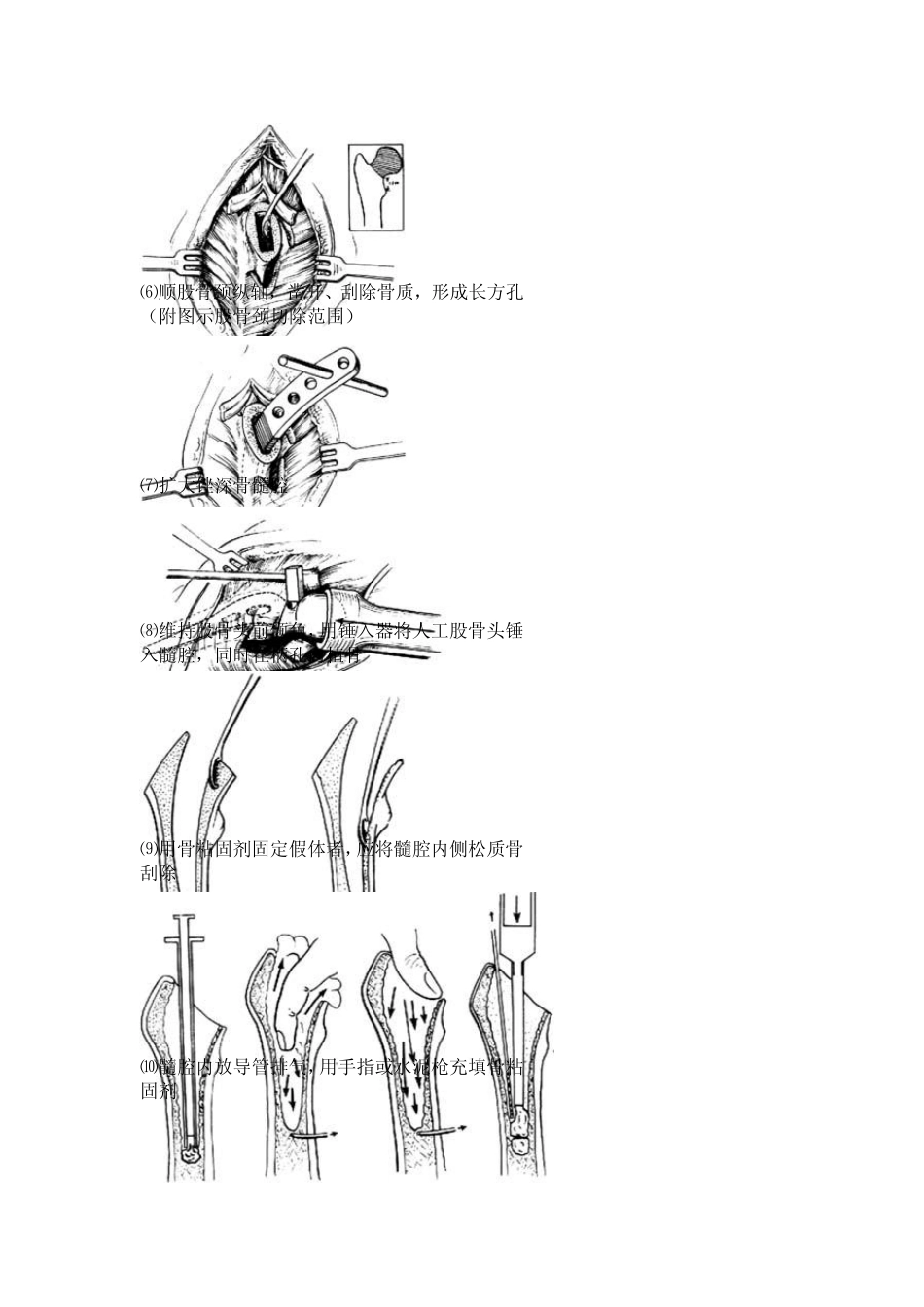 人工股骨头置换术_第2页
